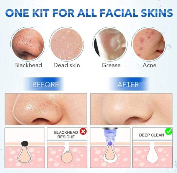 4 IN 1 Blackhead Whitehead Extractor Remover Device (Vaccum Suction Tool) - Image 2